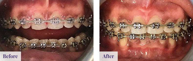 Frenectomy