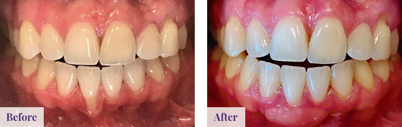 Gingeval Graft